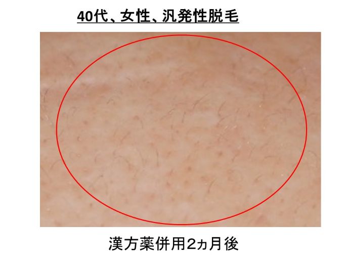 円形脱毛症　病院